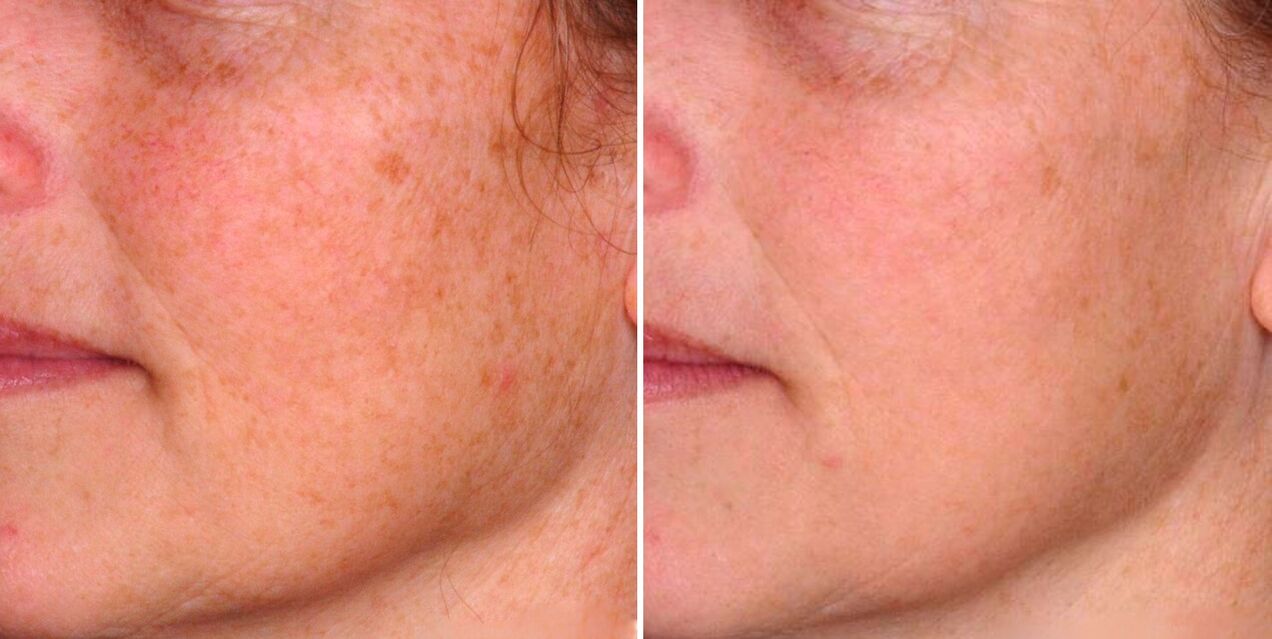 部分的な光熱分解の結果は、顔の皮膚のシミの減少です。